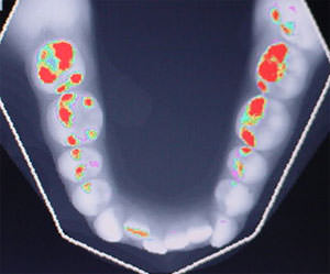 Fig. 10 Oclusograma inferior