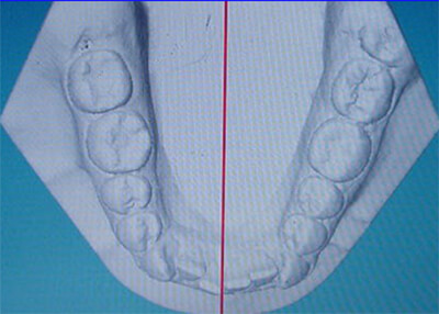 Fig. 12 Línea media inferior