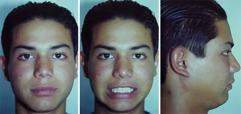 Fig. 21, 22 y 23