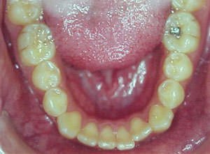 Fig. 29 Oclusal inferior
