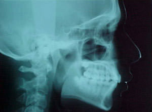 Fig. 31 Rx lateral