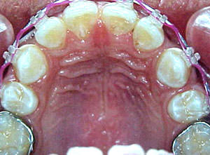 Fig. 35 Oclusal superior