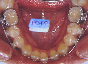 Fig. 36 Oclusal inferior