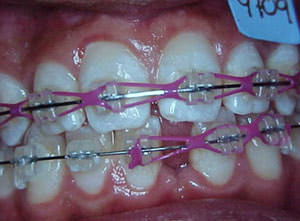 Fig. 37 Frontal