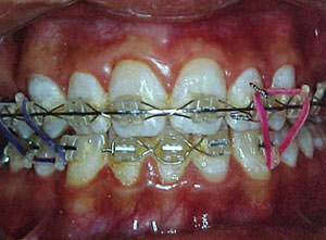 Fig. 42 Detallado e interdigitado
