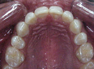 Fig. 45 Oclusal superior