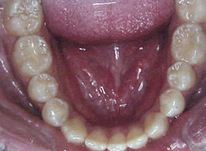 Fig. 46 Oclusal inferior
