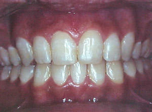 Fig. 49 Frontal final