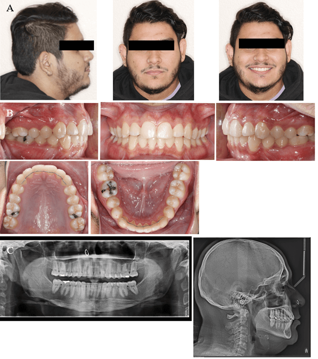 Fig. 4, Fotos faciales finales (A). Fotos intraorales finales (B). Radiografía panorámica final y telerradiografía lateral final (C)