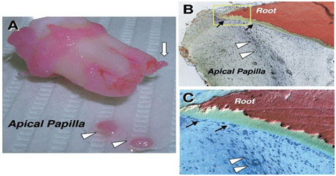 Apical papilla. (A) An extracted human third molar depicting three immature roots with two pieces of apical papilla being removed from their apices (arrow heads) and one piece of apical papilla being peeled away from the root end but not completely detached (arrow). (B) A developing root tip with attached apical papilla was cultured in vitro for 3 days before being processed for hematoxylin and eosin (H&E) staining. Odontoblasts (black arrows), apical cell-rich zone (open arrowheads), and apical papilla tissue are indicated. (C) Magnified view of the area indicated by the yellow rectangle. From: J Endod. Author manuscript; available in PMC 2009 March 9. Published in final edited form as: J Endod. 2008 June; 34(6): 645-651. doi: 10.1016/j.joen.2008.03.001.