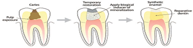Reparación de dentina estimulada por células madres. Tomada de: [Tooth Regeneration in Operative Dentistry. Operative Dent. 2006] (14).