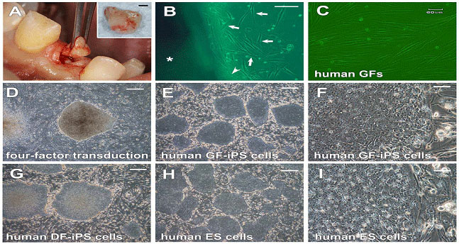Figure 6. Generation of human GF-derived iPS cells. (A) Resection of gingival tissue from the adult patient during dental implant surgery. The resected gingival tissue (inset: scale bar; 1 mm) is generally treated as biomedical waste. (B) Fibroblasts (arrow) and epithelial cells (arrowhead) migrated out of the human gingival tissue (asterisk). Scale bar; 100 mm. (C) The morphology of established hGFs (Passage 4). Scale bar; 60 mm. (D) The morphology of a colony derived from hGFs 26 days after transduction of the four factors. Scale bar; 500 mm. (E-I) Morphology of (E and F) clonal hGFderived iPS cells (clone 547A-1), (G) human dermal fibroblast-derived iPS cells (DF-iPS cells) and (H and I) human KhES-3 ES cells. Scale bars; 500 mm for E, G and H, and 50 mm for F and I. doi:10.1371/journal.pone.0012743.g00S