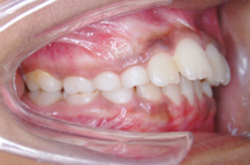 Figure 1 Endon molar relation
