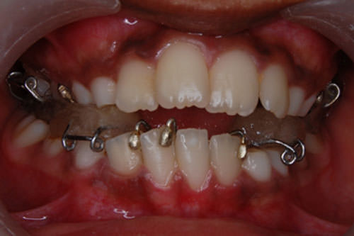 Figure 2 Twin Block appliance for sagittal correction