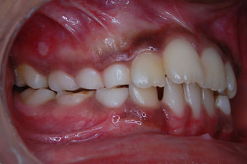 Figure 3 Overcorrected sagittal relation (Prior to dental correction).