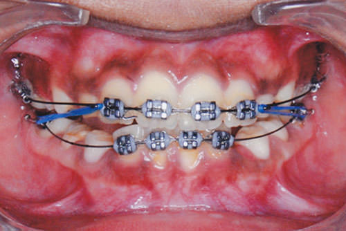 Figure 5 Class II elastics engaged from the upper cuspid circles to the lower molar tube hooks for retention of the Class II sagittal correction. Cephalometric findings.