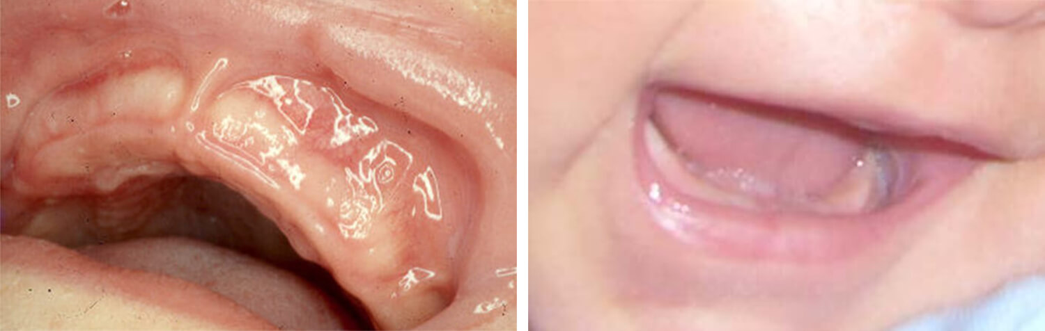 Fig. 2A Rodete superior de un recién nacido / Fig. 2B Rodete inferior de un recién nacido