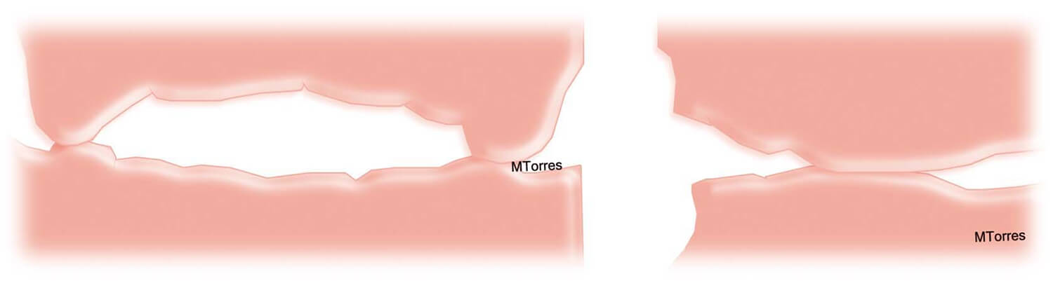 Fig. 3 Representación de la relación anterior y posterior de los rebordes alveolares en el recién nacido.®