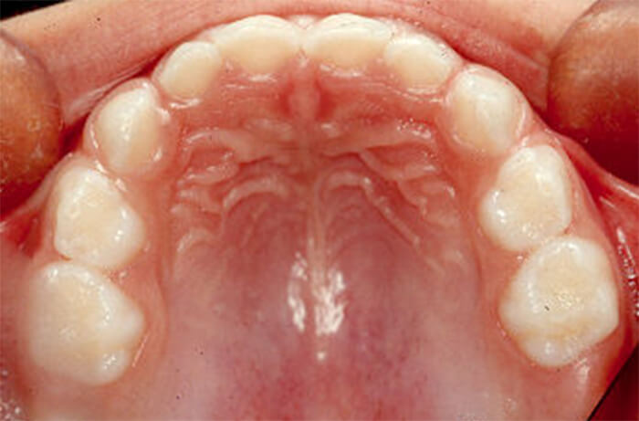 Fig. 7 Erupción del segundo molar primario