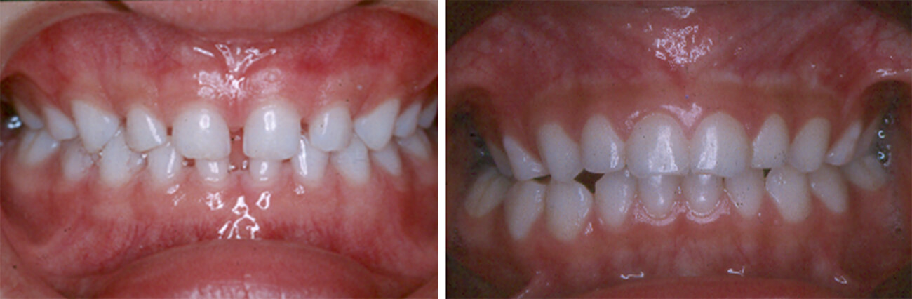 Fig. 8A Dentición primaria espaciada / Fig. 8B Dentición cerrada