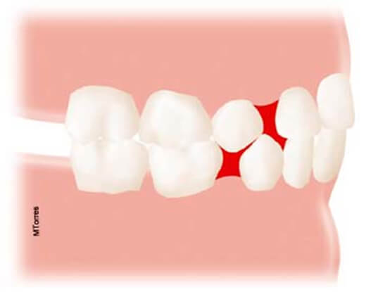 Fig. 9 Espacio primate. Espacio entre los caninos y el primer molar primario en el arco inferior y entre incisivo lateral y el canino primario en el arco superior. ®