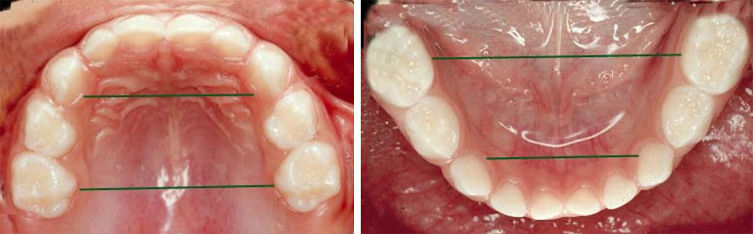 Fig. 10A Ancho intercanino y ancho intermolar medido en el arco superior, según método de Baume / Fig. 10B Medido en el arco inferior