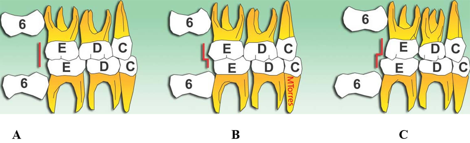 Fig. 12 Esquema de los tres tipos de planos terminales ® A. Plano terminal recto, B. escalón mesial C. Escalón distal