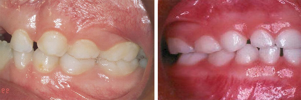 Fig. 13A Plano terminal recto en una dentición Primaria / Fig. 13B Escalón mesial en una dentición primaria