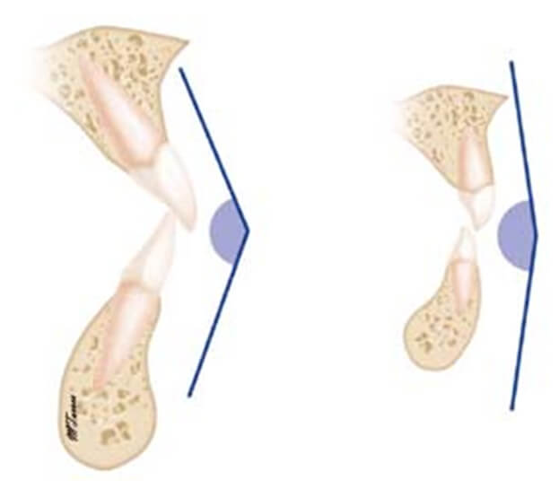 Fig. 15 Plano terminal recto en una dentición Primaria. B. Escalón mesial en una dentición primaria. ®