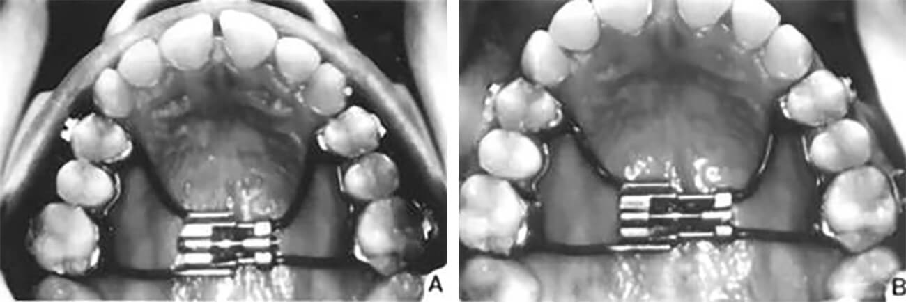 Figura 3. Respuesta típica del maxilar después de una activación diaria con un expansor tipo Hyrax, A) Después de 14 días de activación. B) Después de 28 días de activación. Observe el desarrollo del diastema en la línea media.