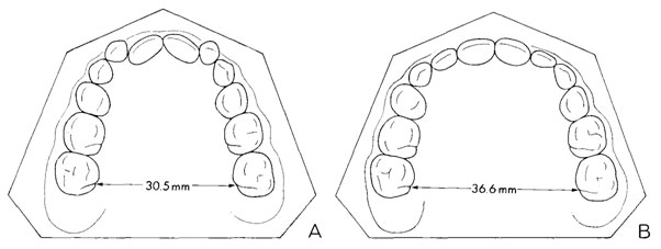 Figura 5 Cambios dimensionales típicos de] arco maxilar después de la expansión rápida. A) Antes del tratamiento. B) Inmediatamente después de la remoción de la férula acrílica de expansión.