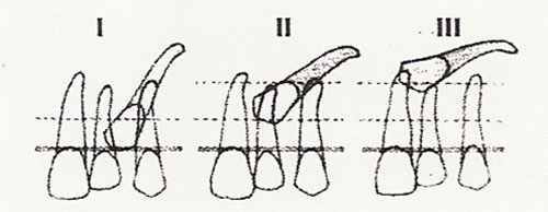 Figura Nº 14 Retenciones dentarias. Posición I, II, III