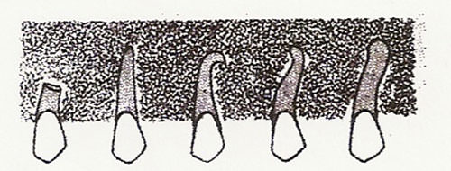 Figura Nº 16 Retenciones dentarias. Estado radicular.