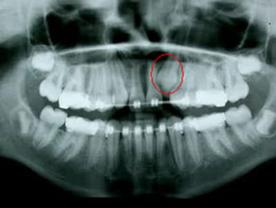 Figura Nº 18 Canino superior retenido en una radiografía panorámica.