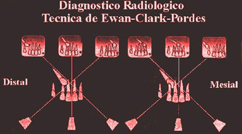 Figura Nº 19 Diagnóstico radiológico Técnica de Ewan-Clark-Pordes.
