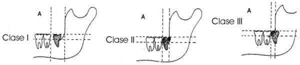 FIGURA 1 Clasificación de impactación del tercer molar inferior. Tomado de Koerner, 1994.