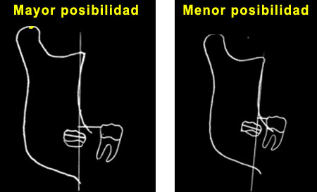 Fig.2 Mediciones según Börk. Tomado de Quiros-Palma
