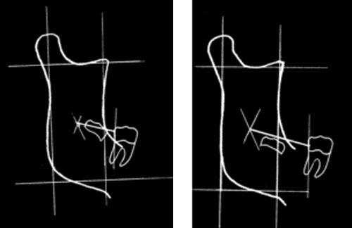 Fig.3 Según Turley en 1974, corroborado por Ricketts 1976. Tomado de Quiros-Plama