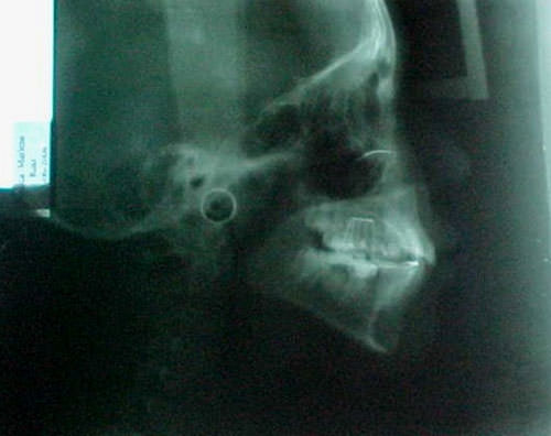 Fig.4 Rx lateral de cráneo inicial