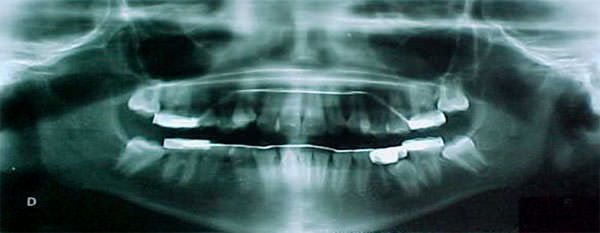 Fig.5 Rx panorámica inicial se observan los 29 dientes presentes.