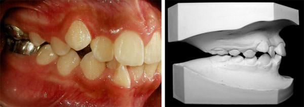 Fig. 6 Fotografía lateral intraoral y su inicial modelo derecha inicial.