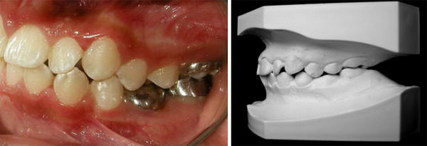 Fig. 7 Fotografía intraoral izquierda de inicio y modelos de estudio