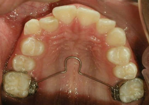 Fig. 8 Fotografía intraoral oclusal superior
