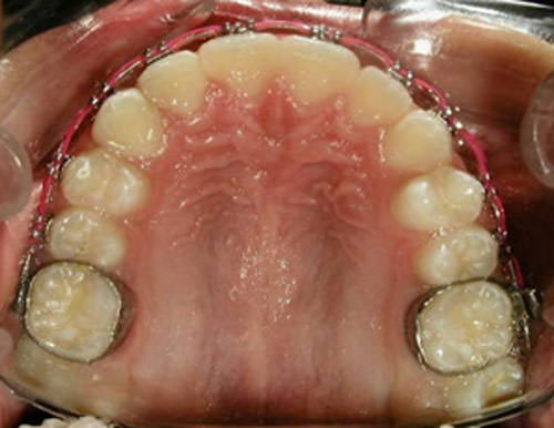 Fig. 12 Fotografía oclusal superior progreso