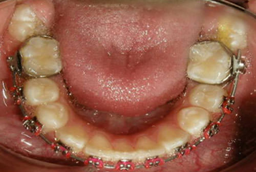 Fig. 13 Fotografía oclusal inferior progreso