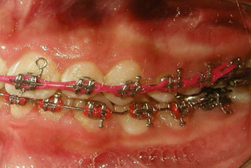 Fig. 16 Lateral izquierda progreso