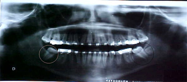 Fig. 18 Radiografía panorámica de progreso.
