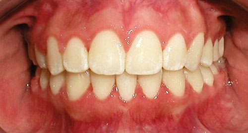 Fig. 22 Fotografía intraoral de frente final