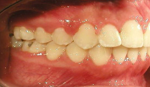 Fig. 23 Radiografía lateral derecha final