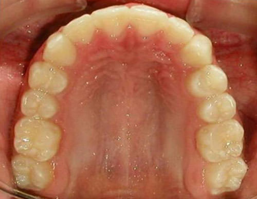 Fig. 25 Fotografía oclusal superior final